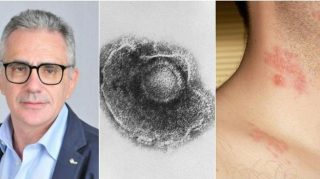 Shingles cases are on the rise, Pregliasco: "Pay attention to your eyes if..." More...