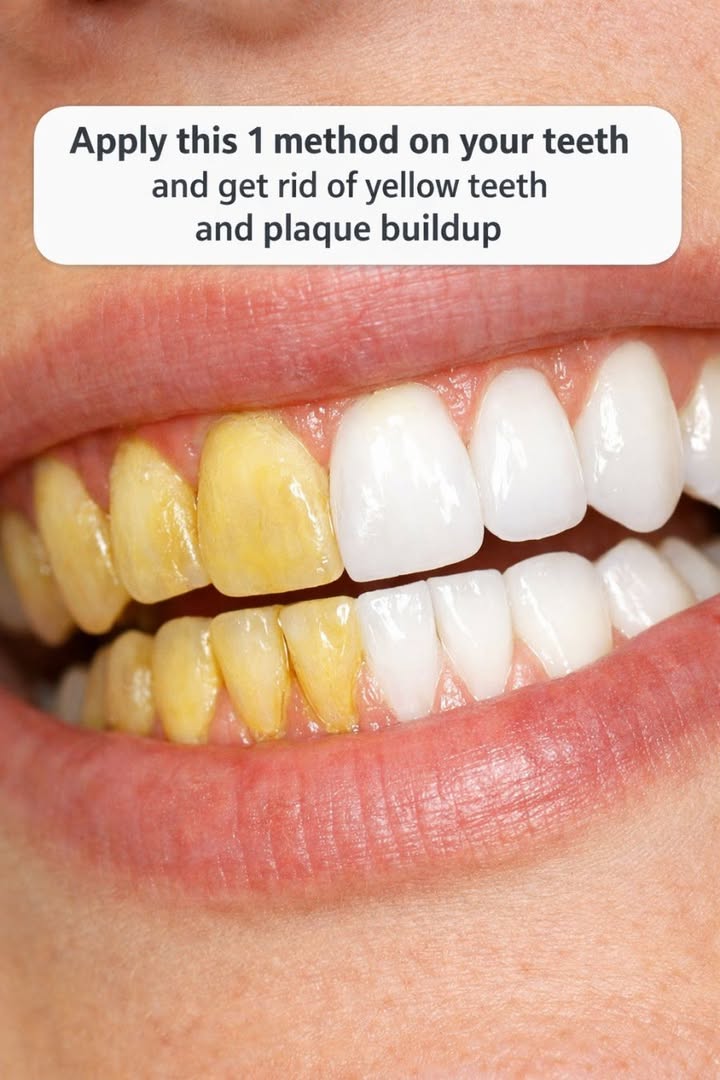 Apply this 1 method on your teeth and get rid of yellow teeth and plaque buildup