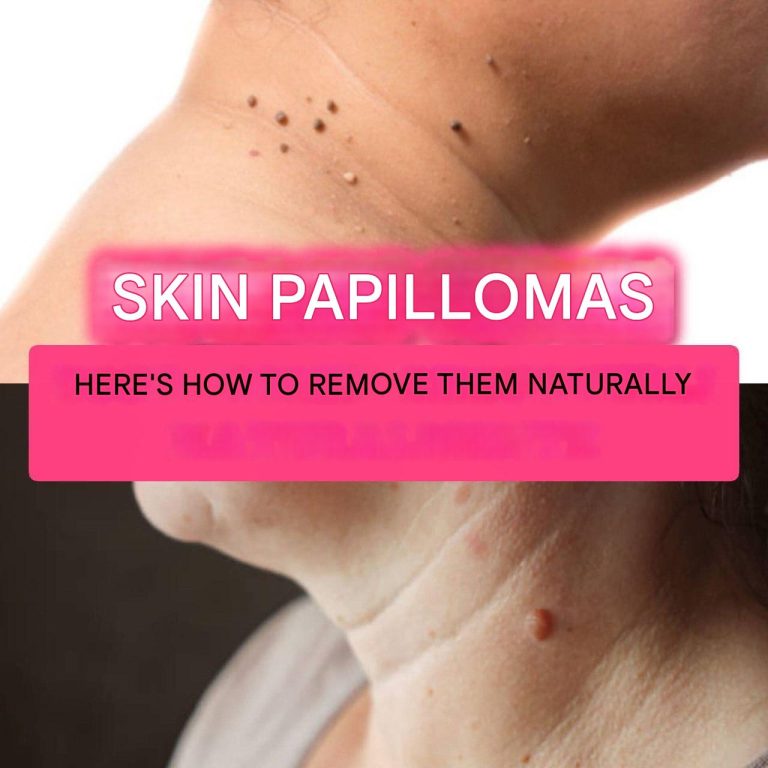 Skin papillomas: here are 4 ways to eliminate them: simply but...More...