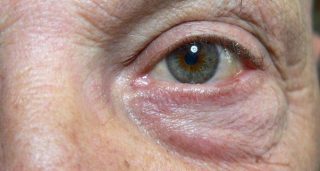 Floaters: What are the floaters you see in your eyes?