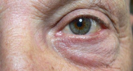 Floaters: What are the floaters you see in your eyes?